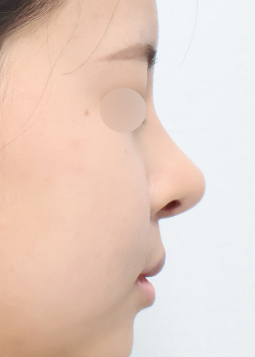 미용코 + 기능코 기능코성형 측면 수술 후 3개월차 전후사진