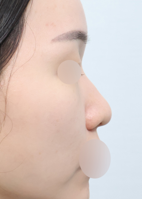 미용코+기능코 기능코성형 측면 수술 전 11일차 전후사진