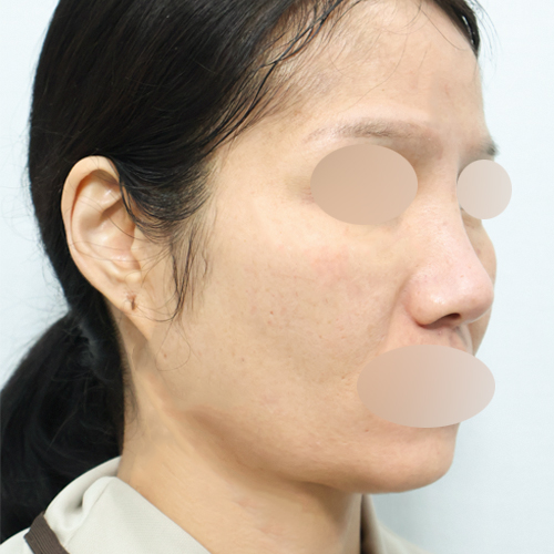 지방이식(얼굴전체) 동안성형 45도 시술 전 3주차 전후사진