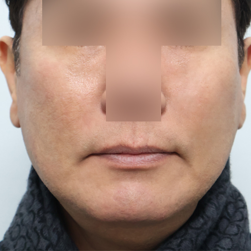지방이식(관자/팔자/눈밑/옆볼꺼짐) 동안성형 정면 시술 후 1개월차 전후사진