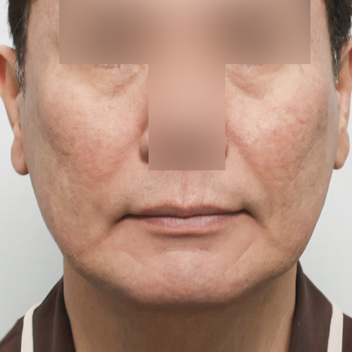 지방이식(관자/팔자/눈밑/옆볼꺼짐) 동안성형 정면 시술 전 1개월차 전후사진