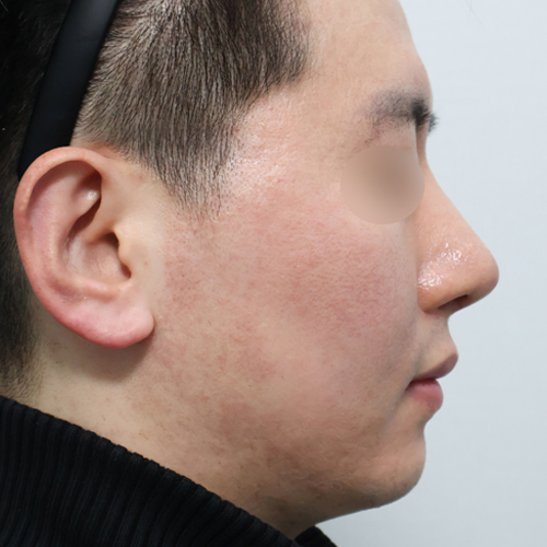 케이비코 시그니처 코성형 측면 수술 후 1개월 전후사진