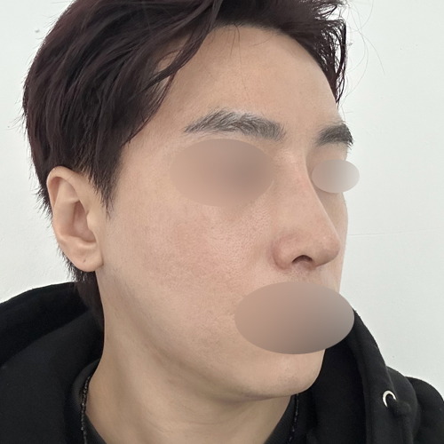 케이립코+코골절 기능코성형 측면 수술 후 1개월차 전후사진