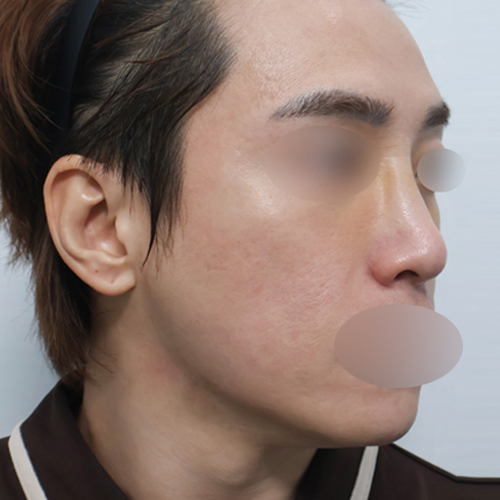 케이립코+코골절 기능코성형 측면 수술 전 1개월차 전후사진
