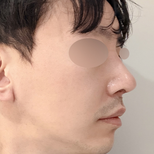 케이립코 시그니처 코성형 측면 수술 후 1개월 전후사진
