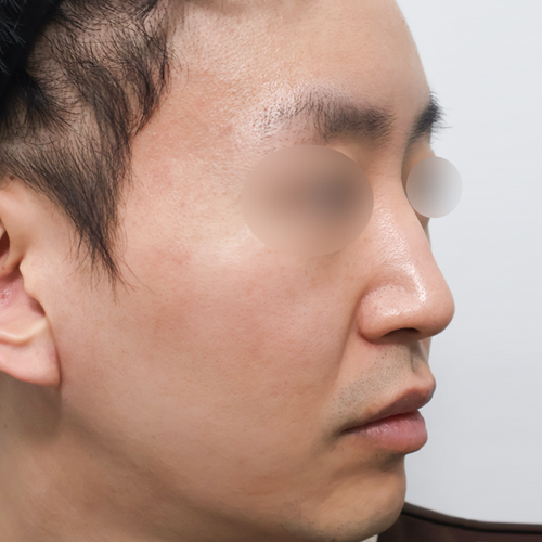 케이립코 시그니처 코성형 측면 수술 전 1개월 전후사진