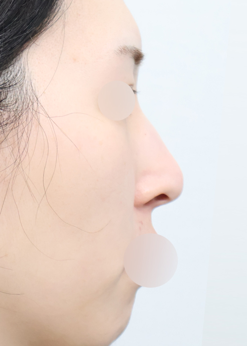 케이립코 측면 시술 전 사진