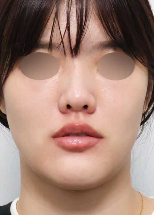 립쥬란 쁘띠 정면 시술 후 당일 전후사진