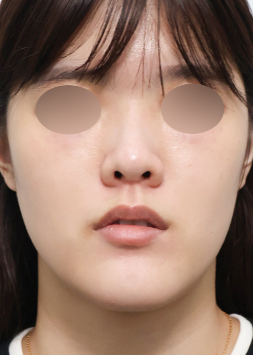 립쥬란 쁘띠 정면 시술 전 당일 전후사진