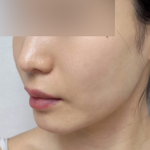 리투오 리프팅 측면 시술 후 2주차 전후사진
