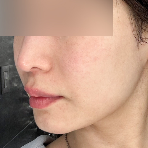 리투오 리프팅 측면 시술 전 2주차 전후사진