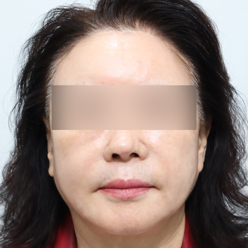 팔자+마리오네트 필러 쁘띠 정면 시술 후 2주차 전후사진