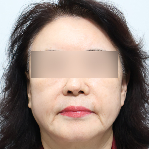 팔자+마리오네트 필러 쁘띠 정면 시술 전 2주차 전후사진