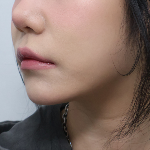 온다리프팅 + 지방분해주사 리프팅 측면 시술 후 1개월 전후사진