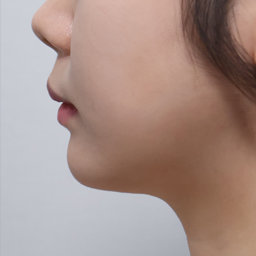 온다리프팅 + 지방분해주사 리프팅 측면 시술 후 1개월 전후사진