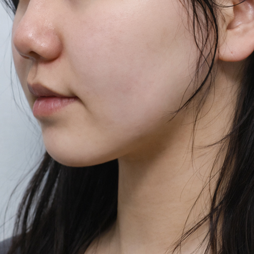온다리프팅 + 지방분해주사 리프팅 측면 시술 후 1개월 전후사진