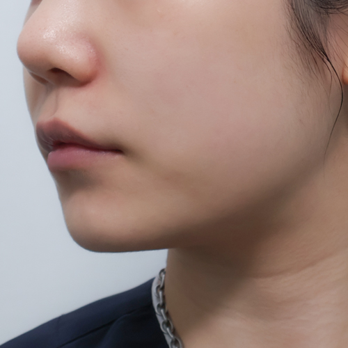 온다리프팅 + 지방분해주사 리프팅 측면 시술 전 1개월 전후사진