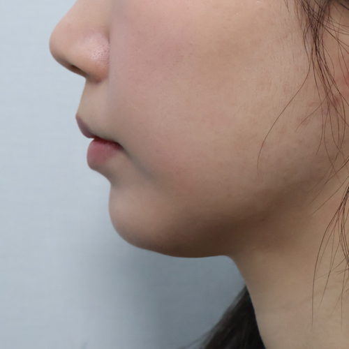 온다리프팅 + 지방분해주사 리프팅 측면 시술 전 1개월 전후사진