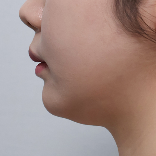 온다리프팅 + 지방분해주사 리프팅 측면 시술 전 1개월 전후사진