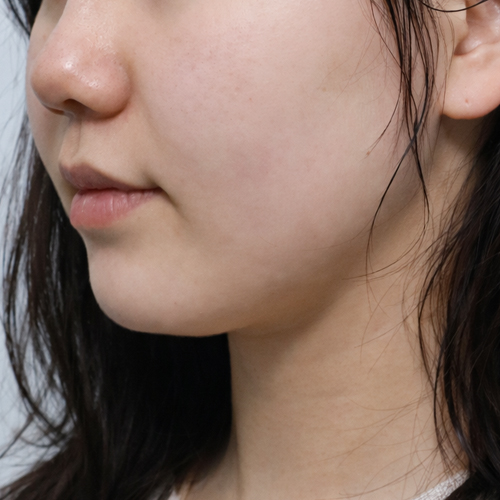 온다리프팅 + 지방분해주사 리프팅 측면 시술 전 1개월 전후사진