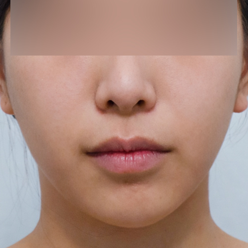 온다리프팅 + 포트라 리프팅 정면 시술 후 1개 전후사진
