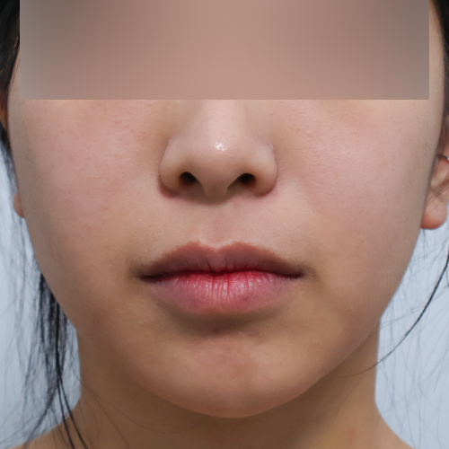 온다리프팅 + 포트라 리프팅 정면 시술 전 1개 전후사진