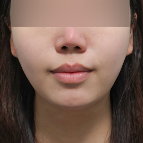 온다리프팅 + 슈링크 리프팅 정면 시술 후 1개월 전후사진
