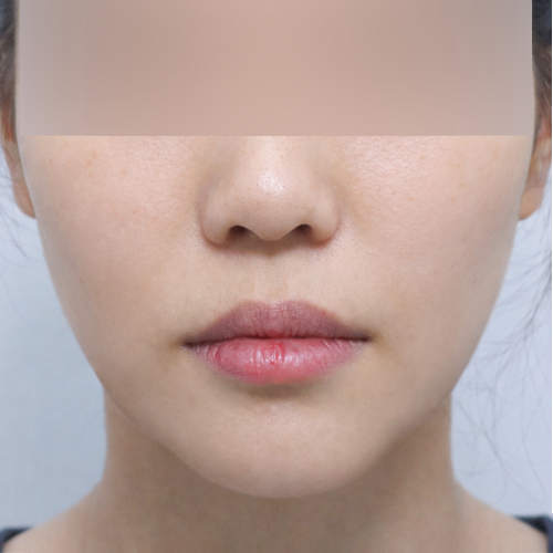 온다리프팅 + 슈링크 리프팅 정면 시술 후 1개월 전후사진