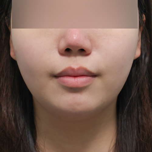 온다리프팅 + 슈링크 리프팅 정면 시술 전 1개월 전후사진