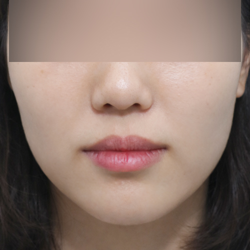온다리프팅 + 슈링크 리프팅 정면 시술 전 1개월 전후사진