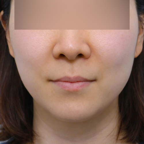 온다리프팅 리프팅 시술 후 1개월 전후사진