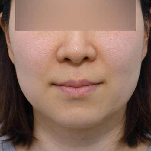 온다리프팅 리프팅 시술 전 1개월 전후사진