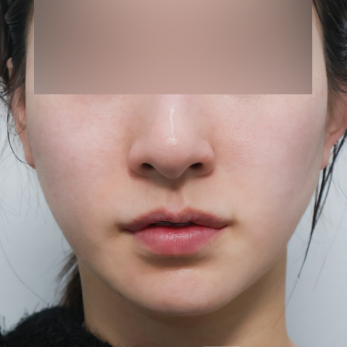 포트라 + 리투오 리프팅 정면 시술 후 2주 전후사진