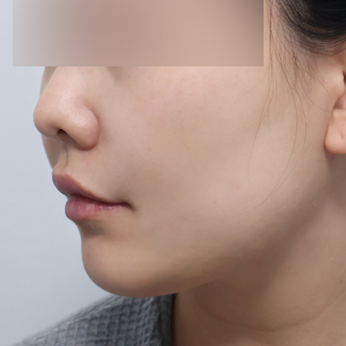 포트라 + 리투오 리프팅 측면 시술 후 1개월 전후사진