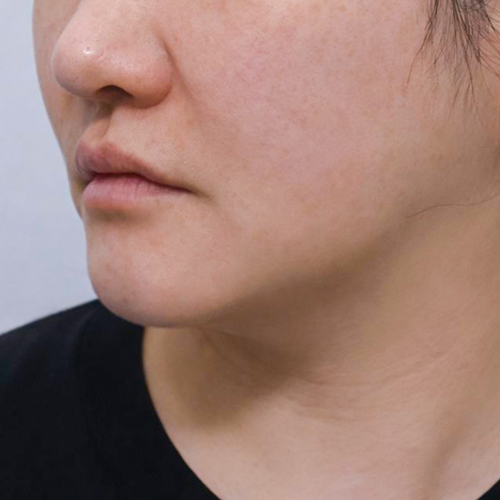포트라 + 리투오 리프팅 측면 시술 전 1개월 전후사진