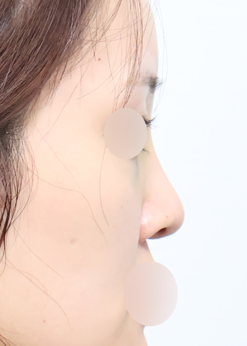 재수술+코뼈골절+기증늑 기능코성형 측면 수술 전 3주차 전후사진