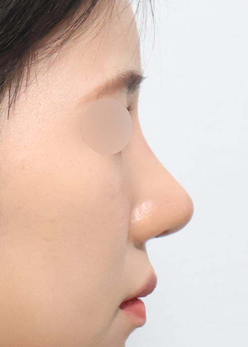 재수술 실리콘+자가늑 기능코성형 측면 수술 후 5주차 전후사진