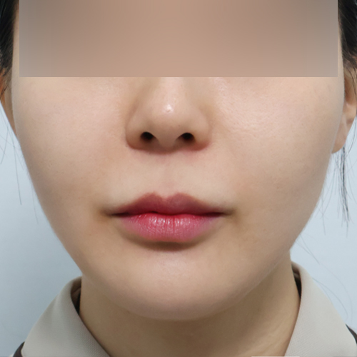 써마지 + 리투오 리프팅 정면 시술 후 1개월 전후사진