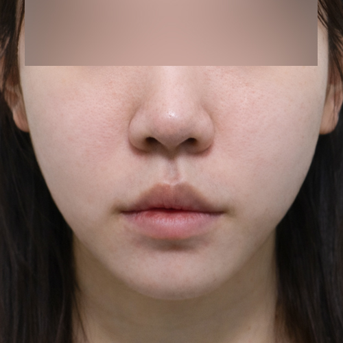 써마지 + 리투오 리프팅 정면 시술 후 1개월 전후사진