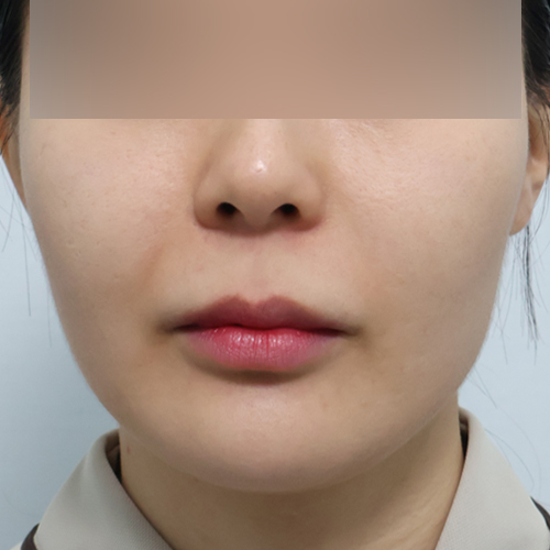 써마지 + 리투오 리프팅 정면 시술 전 1개월 전후사진