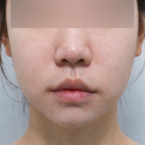 써마지 + 리투오 리프팅 정면 시술 전 1개월 전후사진