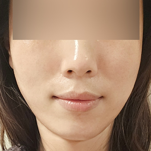 볼뉴머 + 슈링크 + 포트라 리프팅 정면 시술 후 2주차 전후사진