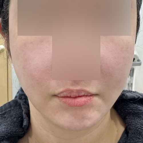 볼뉴머 + 슈링크 + 포트라 리프팅 정면 시술 후 당일 전후사진