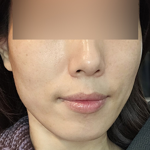 볼뉴머 + 슈링크 + 포트라 리프팅 정면 시술 전 2주차 전후사진