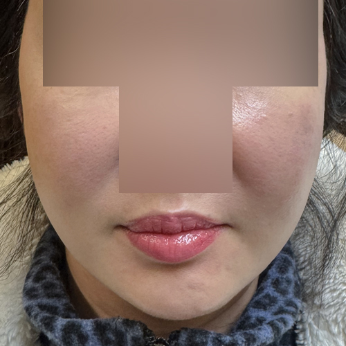 볼뉴머 + 슈링크 + 포트라 리프팅 정면 시술 전 당일 전후사진