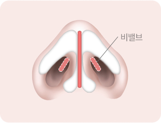 비밸브 재건 수술