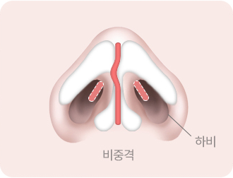 비중격·하비갑개 동시 교정