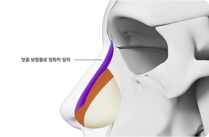 3D 맞춤 코성형