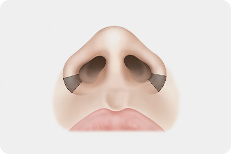 콧볼과 볼의 경계를 따라 절제
