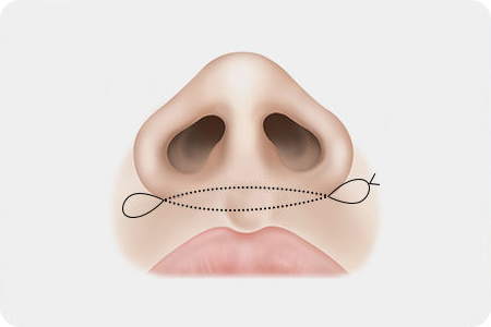콧볼 양쪽으로 실을 삽입